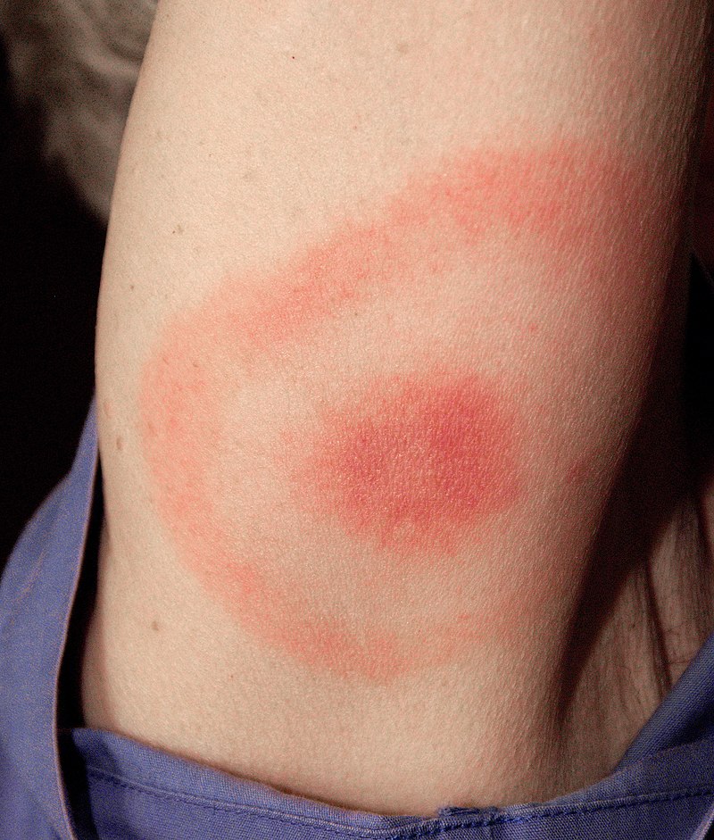 800px Erythema migrans erythematous rash in Lyme disease PHIL 9875