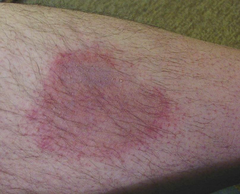 Nowa aplikacja ostrzega mieszkańców Holandii przed... kleszczami! 11 Erythema motilans